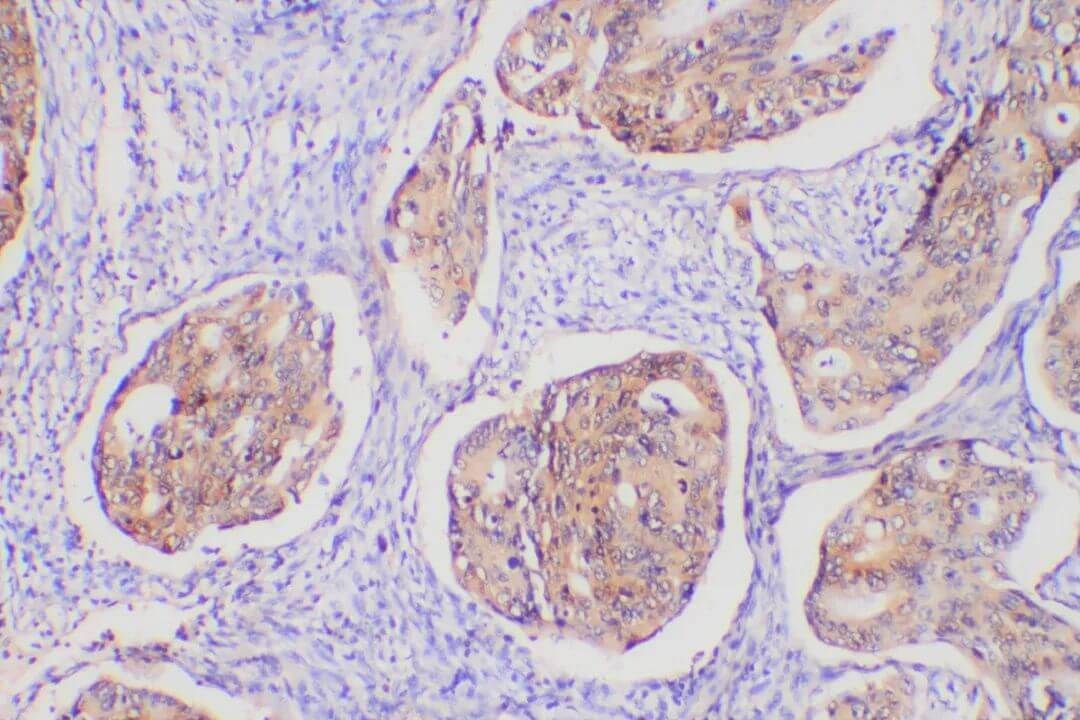 colon cancer immunostaining