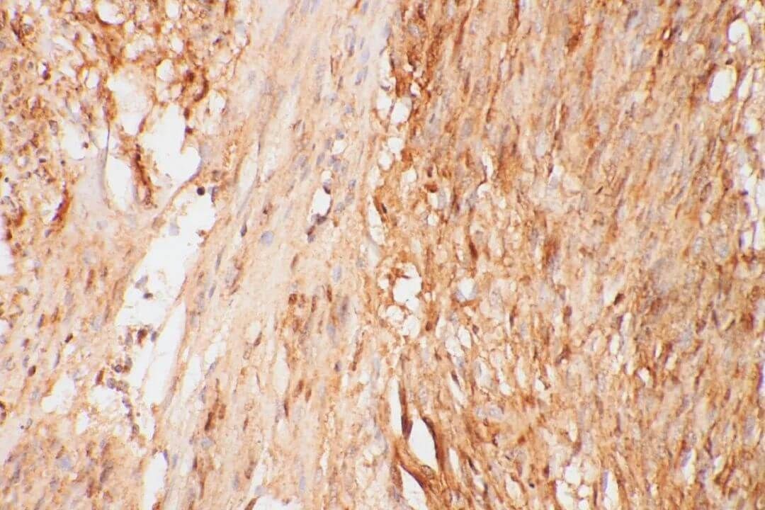 gastric cancer immunostaining