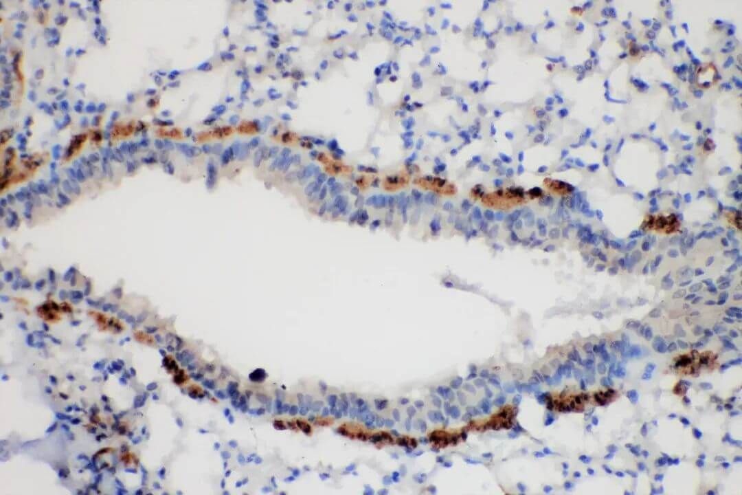 Immunohistochemistry Test for Lung Cancer