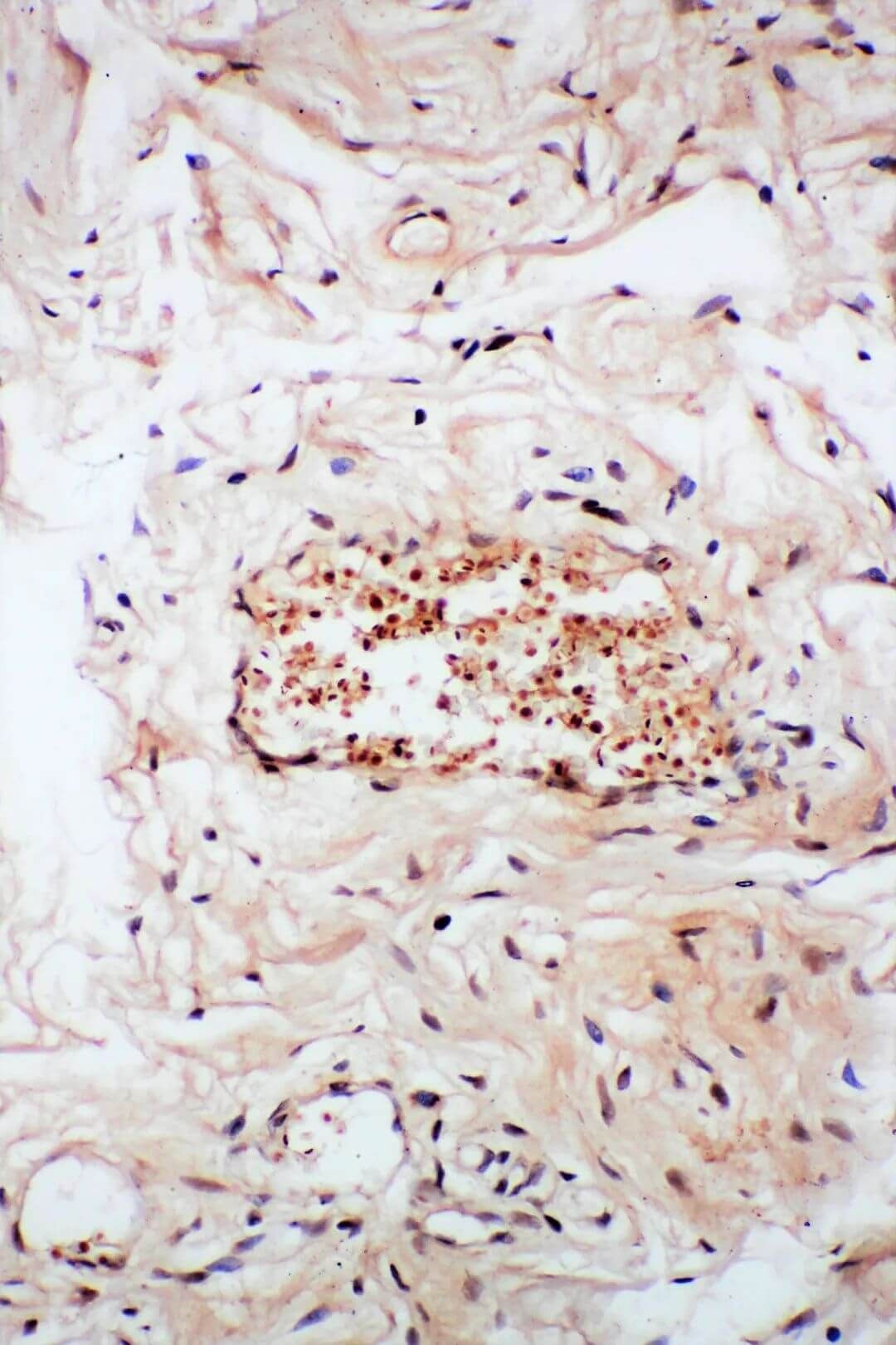 Immunohistochemistry Test for Cervical Carcinoma