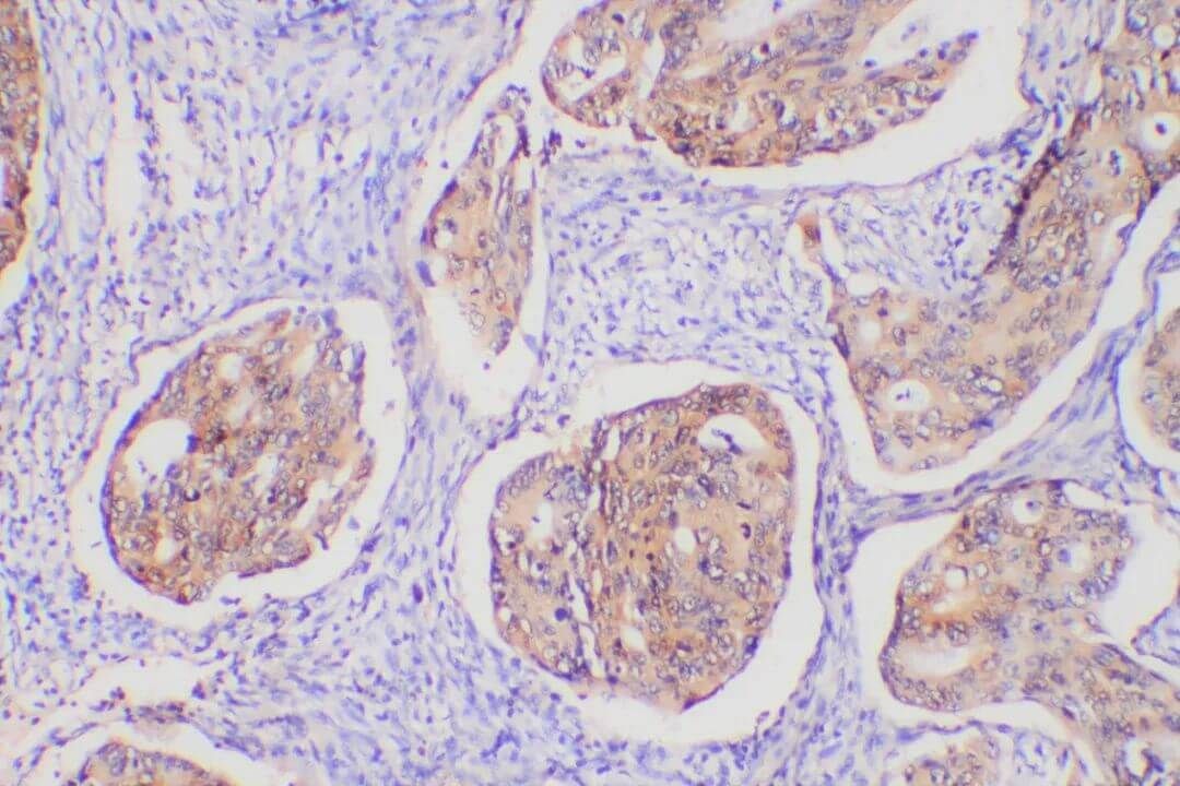 IHC Background Staining for Colon Cancer