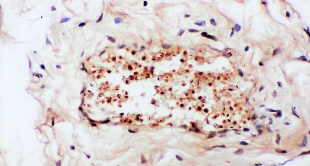 IHC Test for Human Cervical Cancer Tissue (Intermolecular Forces)