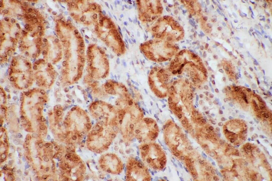 IHC Background Staining for Kidney Cancer