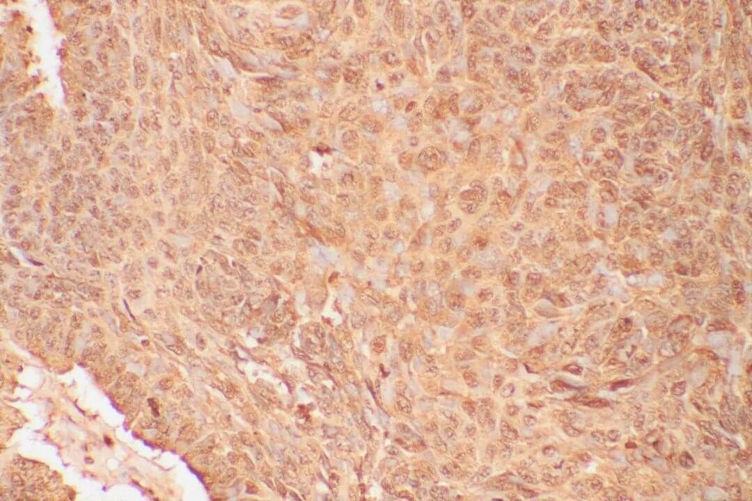 IHC Background Staining for Liver Cancer