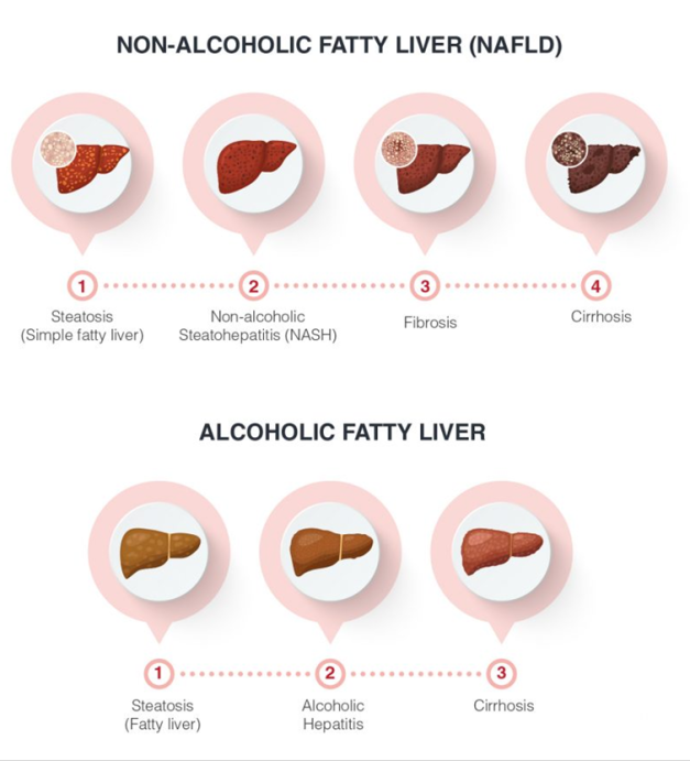 fatty liver disease