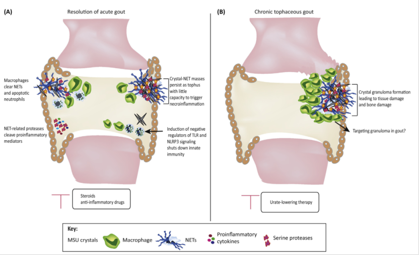 Chronic Gout